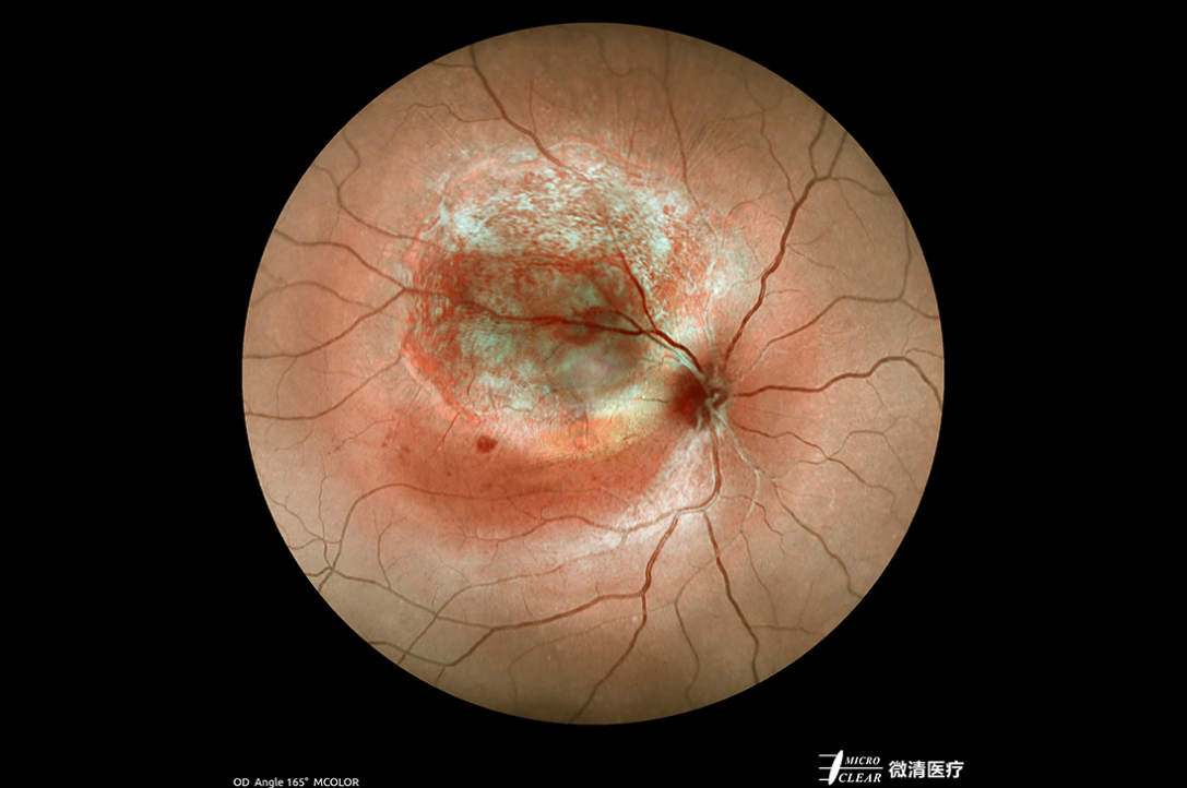 脉络膜血管瘤最新治疗方法概述